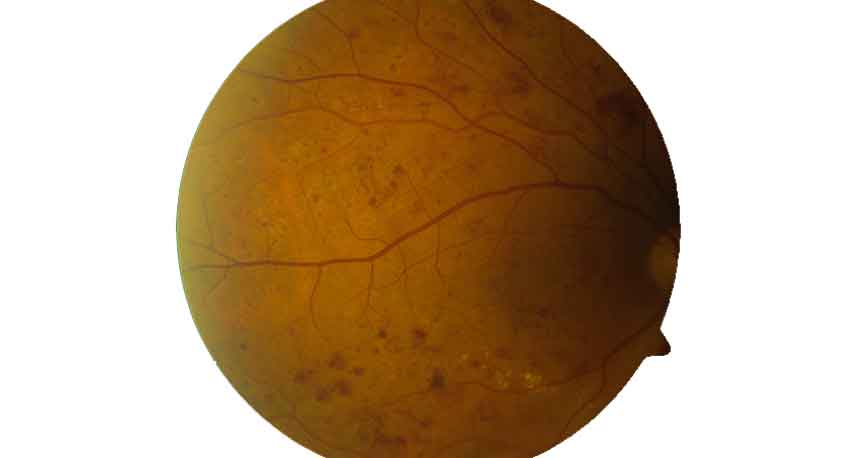 diabetsiche Retinopathie